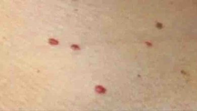 Photo of Red Dots on Your Skin: Causes and What They Could Mean